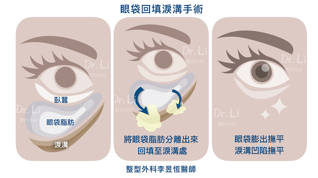 眼袋回填淚溝手術，是將眼袋脂肪向下推至凹陷的淚溝處