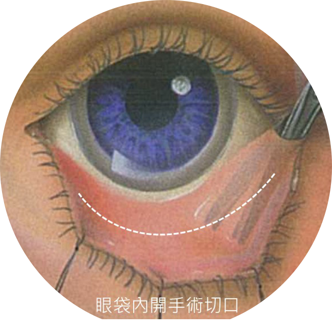 眼袋內開手術的切口位置範例