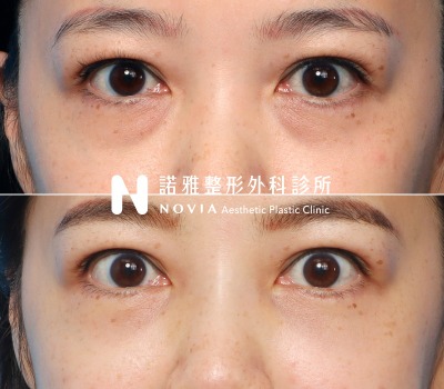 諾雅整形外科診所眼袋手術案例照