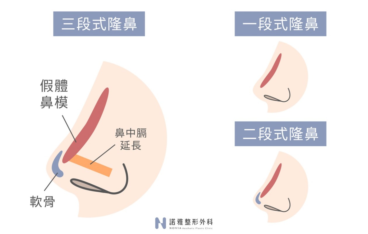 結構式隆鼻手術與傳統一段式、二段式隆鼻手術的不同