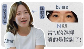 【無痕式眼袋見證】當初這個選擇，真的是做對了！ 李昱恆醫師｜諾雅整形外科